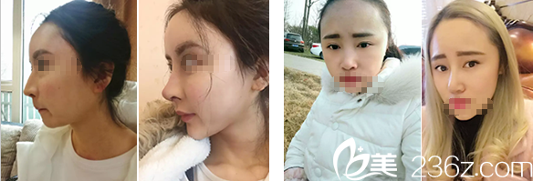 蔣代為鼻整形案例對(duì)比圖