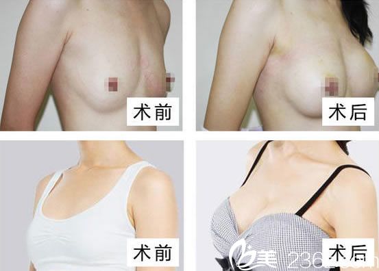 衢州芘麗芙彭愛芳隆胸案例 衢州芘麗芙彭愛芳隆胸案例