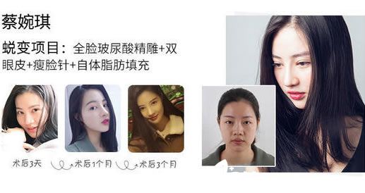 羅輝醫(yī)生注射玻尿酸案例