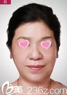 衡水天宏整形醫(yī)院做埋線提升效果好嗎？看真人案例展示