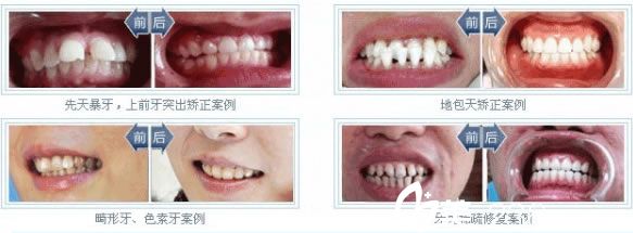 徐小飛醫(yī)生做的美容冠案例 徐小飛醫(yī)生做的美容冠案例