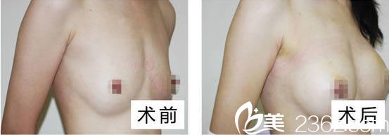 麥格假體隆胸的效果怎么樣 麥格假體隆胸的效果怎么樣