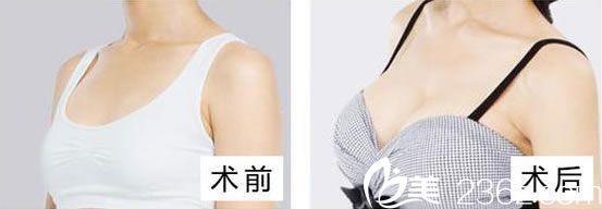 芘麗芙假體隆胸案例 芘麗芙假體隆胸案例