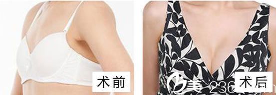 彭愛芳做的隆胸效果怎么樣 彭愛芳做的隆胸效果怎么樣