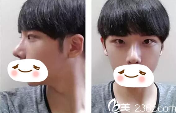 術(shù)后兩周恢復(fù)情況 術(shù)后兩周恢復(fù)情況