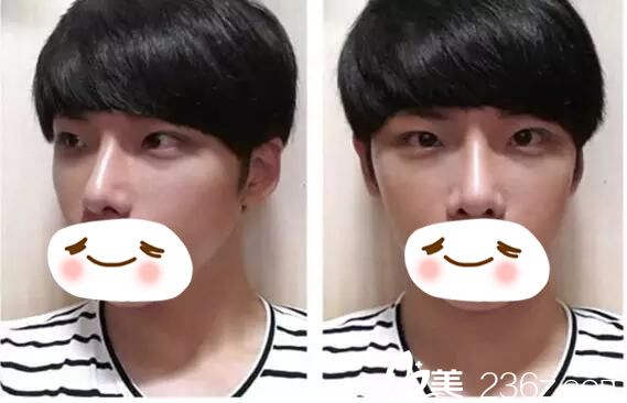 術(shù)后一個月恢復(fù)情況 術(shù)后一個月恢復(fù)情況