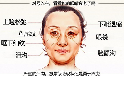 眼袋    眼部問題