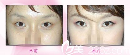 手術(shù)前后對比圖     祛眼袋手術(shù)