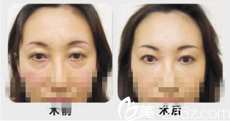 祛眼袋手術(shù)前后對比圖