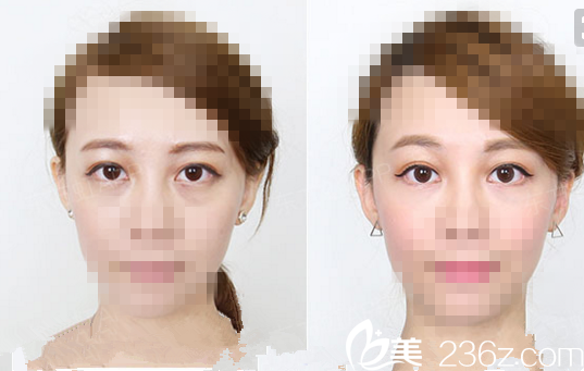    祛眼袋手術(shù)前后圖