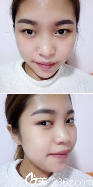 做雙眼皮和隆鼻手術(shù)前的照片 做雙眼皮和隆鼻手術(shù)前的照片