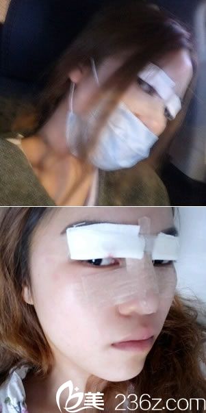 做雙眼皮和隆鼻手術(shù)第2天 做雙眼皮和隆鼻手術(shù)第2天