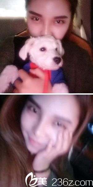 全切雙眼皮手術(shù)第9天效果 全切雙眼皮手術(shù)第9天效果