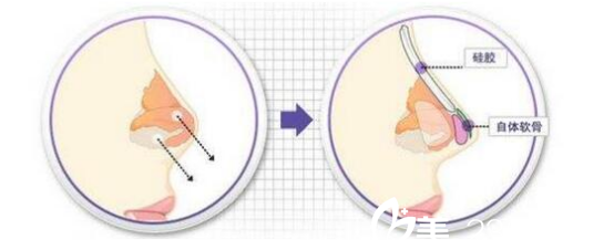 四川達(dá)州雙均整形美容醫(yī)院劉隆才醫(yī)生隆鼻流程 四川達(dá)州雙均整形美容醫(yī)院劉隆才醫(yī)生隆鼻流程