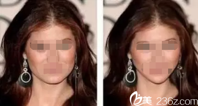 大臉和小V臉的區(qū)別