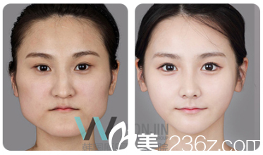 韓國原辰醫(yī)院打造精致小臉案例