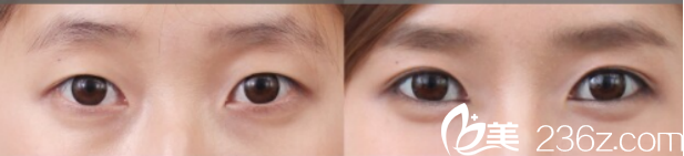 達州雙均整形美容醫(yī)院玻尿酸注射臥蠶的真人案例