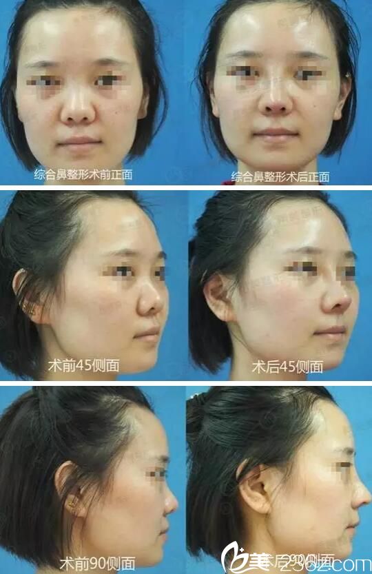 蔣松林隆鼻案例 蔣松林隆鼻案例