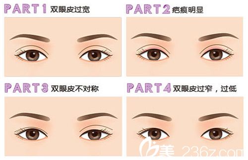 眼部整形失敗的情況