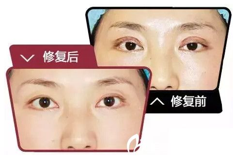 再次眼部整形前后對(duì)比圖