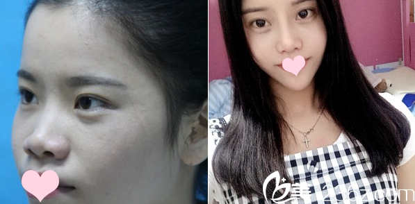 廣州曙光整形醫(yī)院郭建做的隆鼻案例 廣州曙光整形醫(yī)院郭建做的隆鼻案例