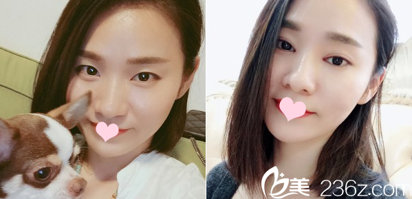 廣州曙光整形醫(yī)院郭建做的雙眼皮案例 廣州曙光整形醫(yī)院郭建做的雙眼皮案例