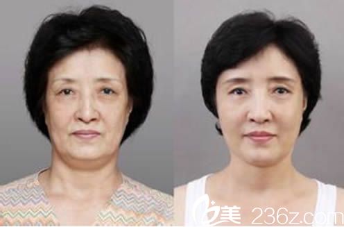 白莉面部除皺對比效果圖 白莉面部除皺對比效果圖