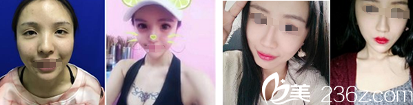 孫文強玻尿酸注射案例及面部脂肪填充案例 孫文強玻尿酸注射案例及面部脂肪填充案例