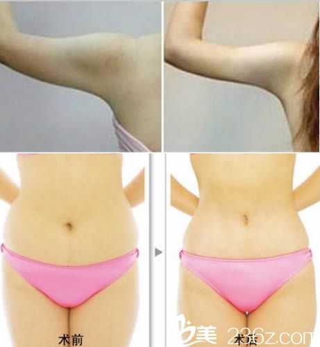 倪少杰手臂和腹部吸脂案例 倪少杰手臂和腹部吸脂案例