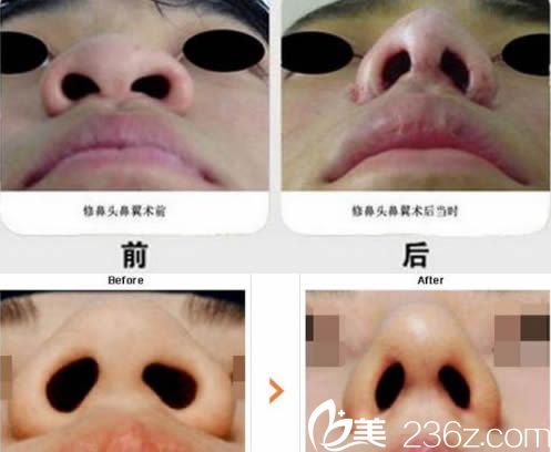 鼻翼整形隆鼻案例 鼻翼整形隆鼻案例