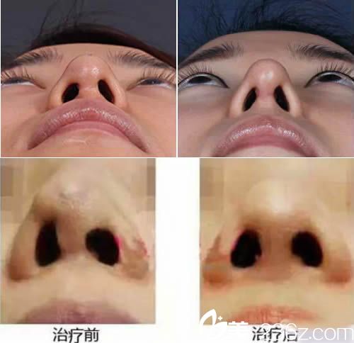 鼻修復(fù)案例圖 鼻修復(fù)案例圖