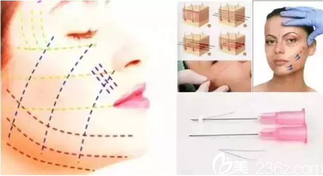 韓國原辰整形線雕面部提升