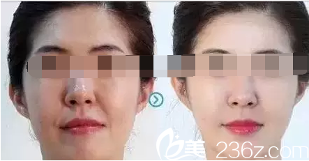 線雕可使表皮層提亮膚色