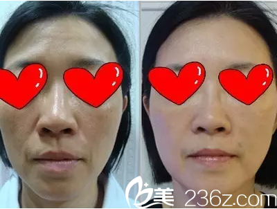 線雕面部提升促進膠原蛋白增生