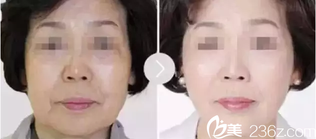 原辰整形線雕支撐皮下組織