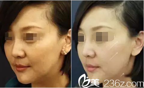 線雕面部提升面部提拉