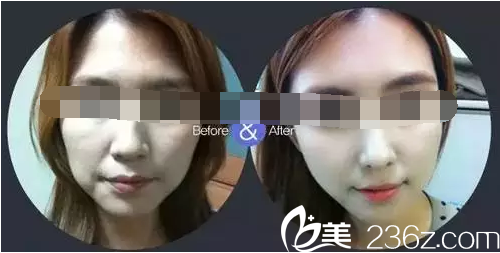 原辰整形使皮膚韌帶恢復緊致彈性