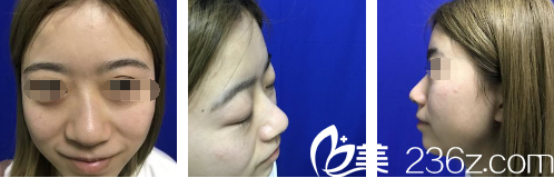 鄧東偉鼻部綜合整形+假體墊下巴術前照 鄧東偉鼻部綜合整形+假體墊下巴術前照