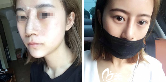 鄧東偉鼻部綜合整形+假體墊下巴拆線效果 鄧東偉鼻部綜合整形+假體墊下巴拆線效果