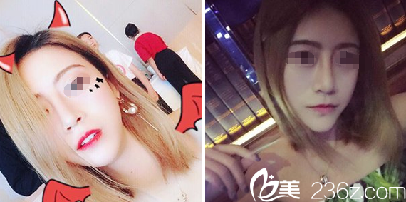 成都西區(qū)醫(yī)院鄧東偉隆鼻+豐下巴術后20天 成都西區(qū)醫(yī)院鄧東偉隆鼻+豐下巴術后20天