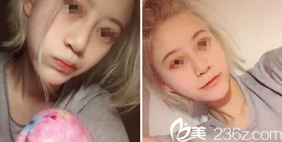 鄧東偉鼻綜合+假體墊下巴手術45天恢復情況 鄧東偉鼻綜合+假體墊下巴手術45天恢復情況