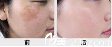 北京圣嘉新顧生祛斑案例 北京圣嘉新顧生祛斑案例