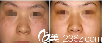 北京圣嘉新祛斑美膚案例 北京圣嘉新祛斑美膚案例