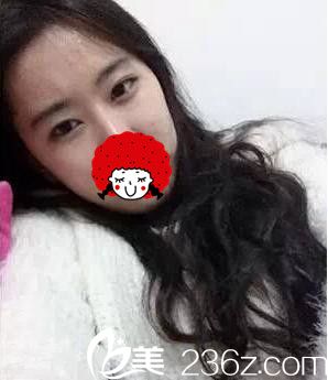 內(nèi)雙想做雙眼皮 內(nèi)雙想做雙眼皮