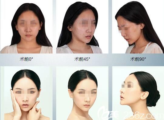 術(shù)前術(shù)后對(duì)比 術(shù)前術(shù)后對(duì)比