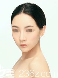 為了完成夢(mèng)想 我選擇先去武漢美萊做隆鼻整形