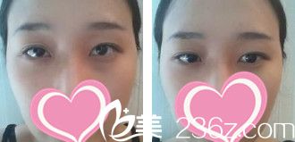 術(shù)前內(nèi)雙的我 術(shù)前內(nèi)雙的我