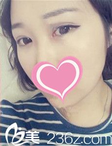 術(shù)后7天雙眼皮樣子 術(shù)后7天雙眼皮樣子