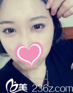 韓式雙眼皮術(shù)后15天恢復(fù)情況 韓式雙眼皮術(shù)后15天恢復(fù)情況