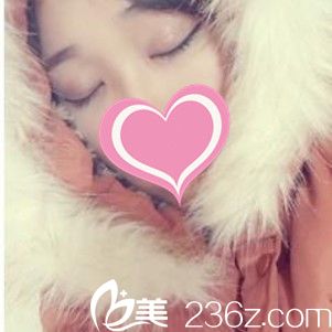 術(shù)后1個月雙眼皮閉眼無痕 術(shù)后1個月雙眼皮閉眼無痕